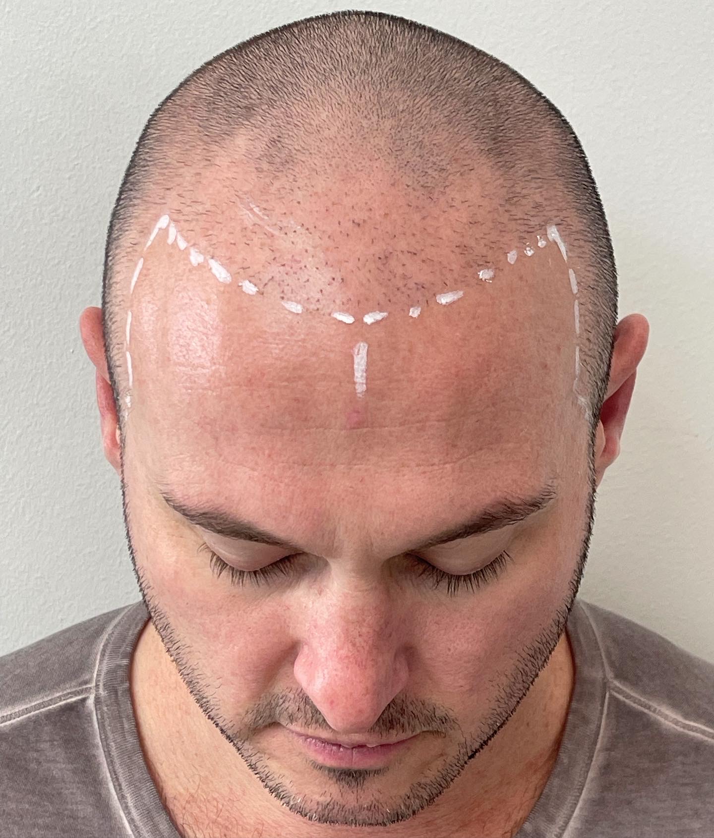 expert scalp micropigmentation in California