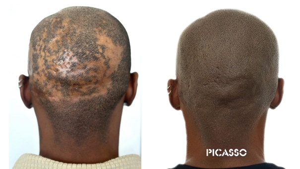 Scalp Micropigmentation in Illinois