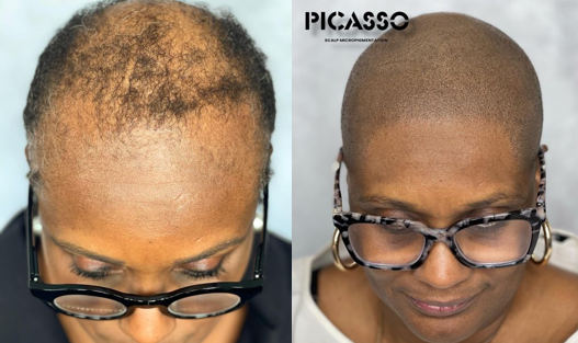 Scalp Micropigmentation San Francisco