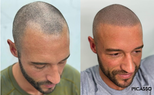 Scalp Micropigmentation California