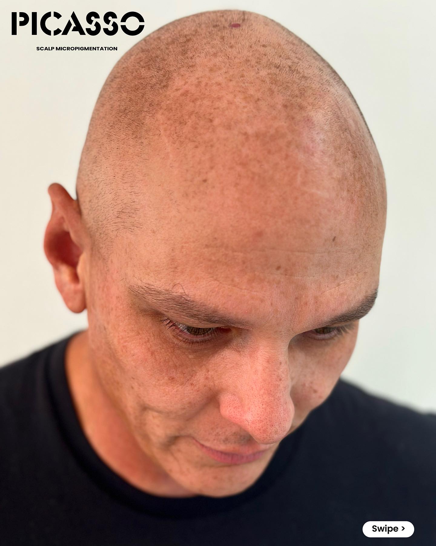 Scalp Micropigmentation Experts