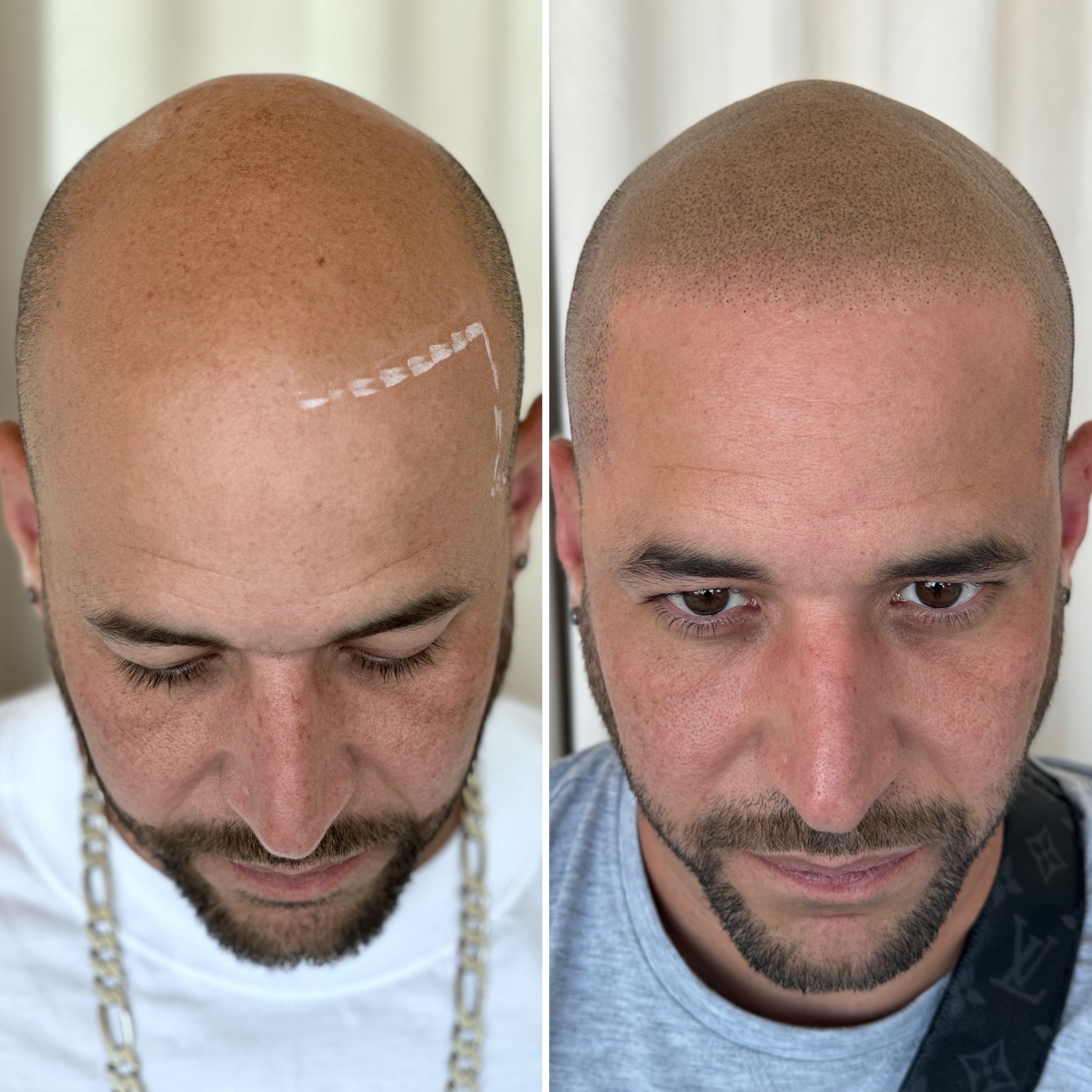 scalp micropigmentation before and after