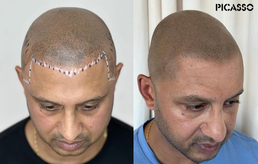 Affordable scalp micropigmentation Illinois