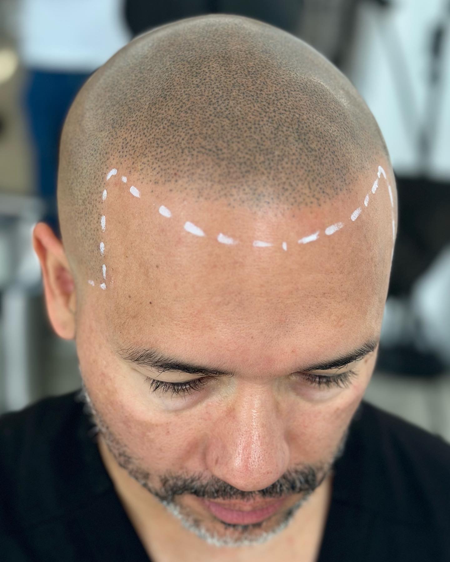 Baldness Treatment