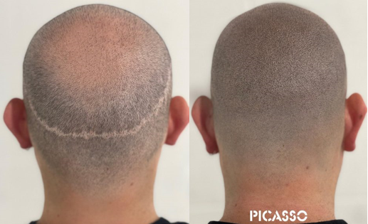 Scalp Micropigmentation Chicago