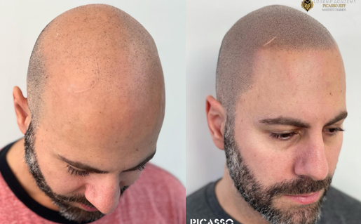 Top 5 Cities for Scalp Micropigmentation