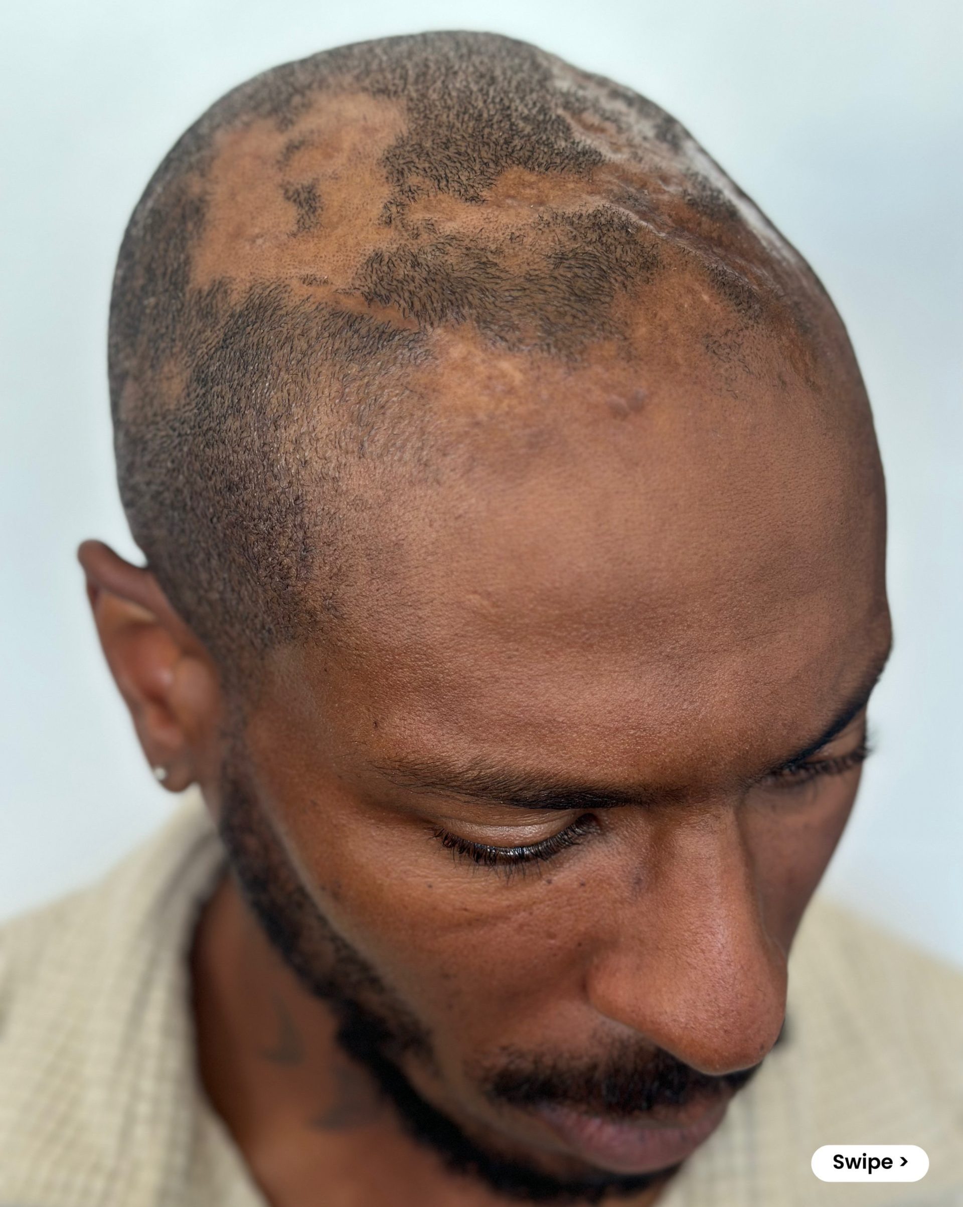 first signs of hair loss