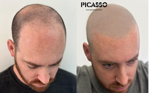 Best Scalp Micropigmentation Clinics in Los Angeles