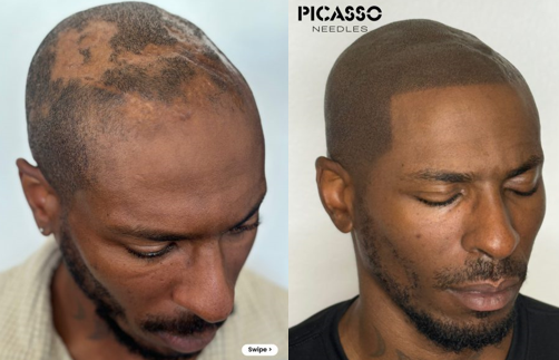 Scalp Micropigmentation Training