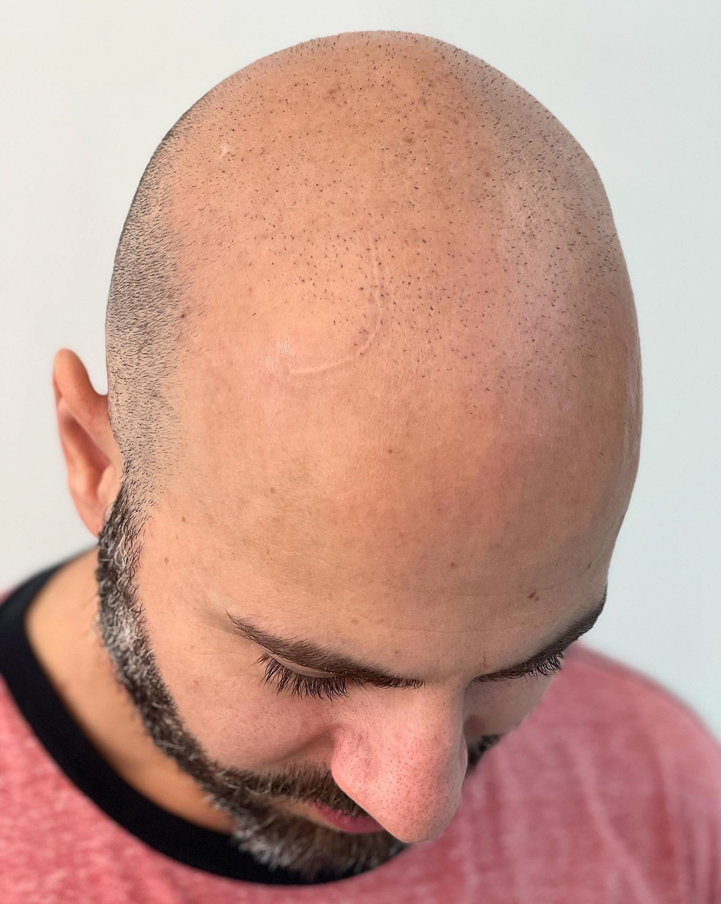 Top 5 Cities for Scalp Micropigmentation in Illinois