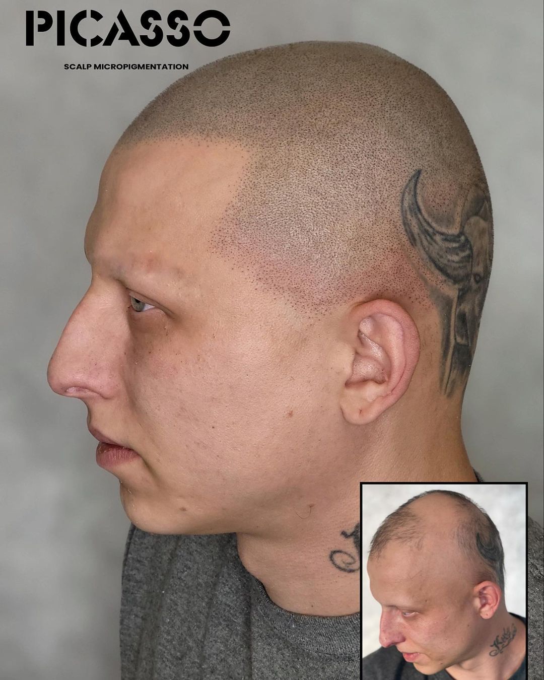 scalp micropigmentation regrets