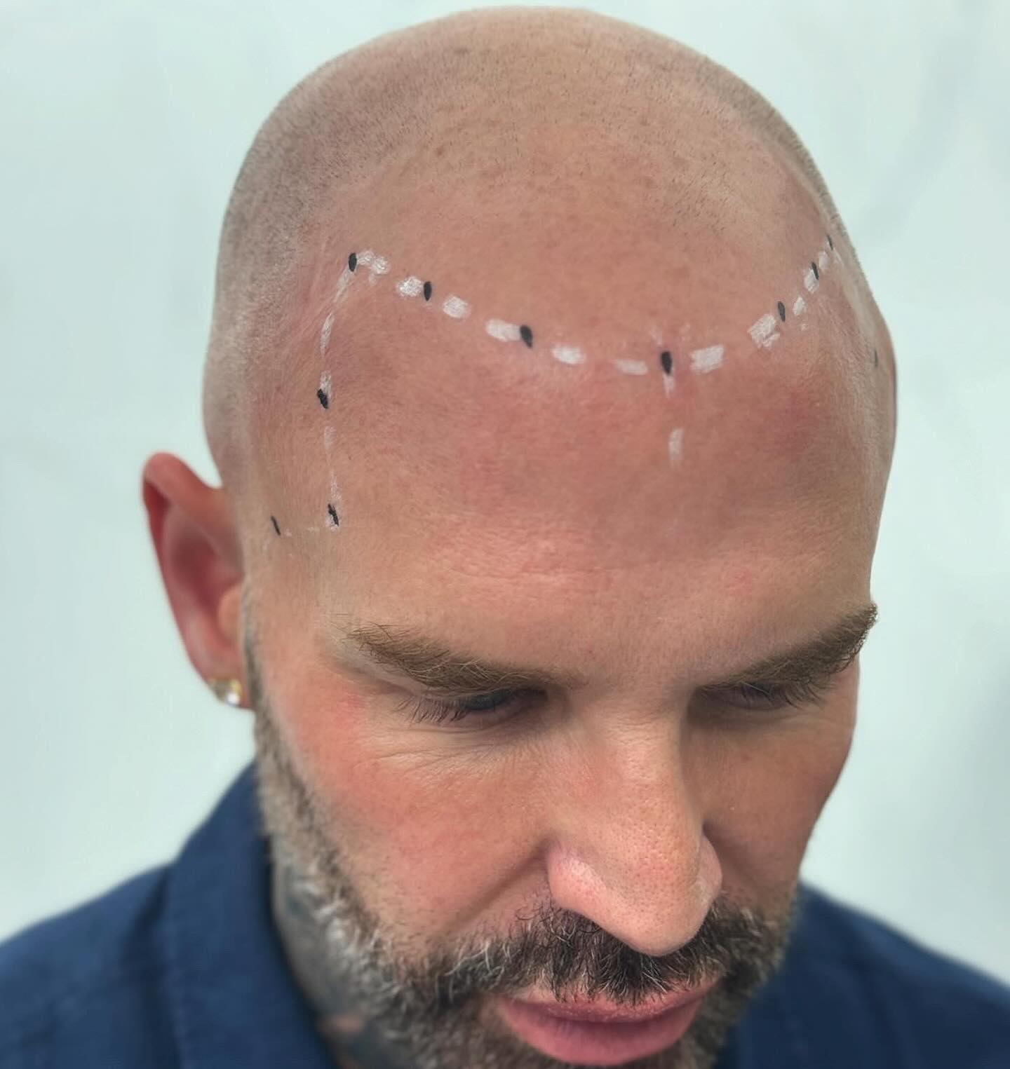 picaso expert scalp micropigmentation