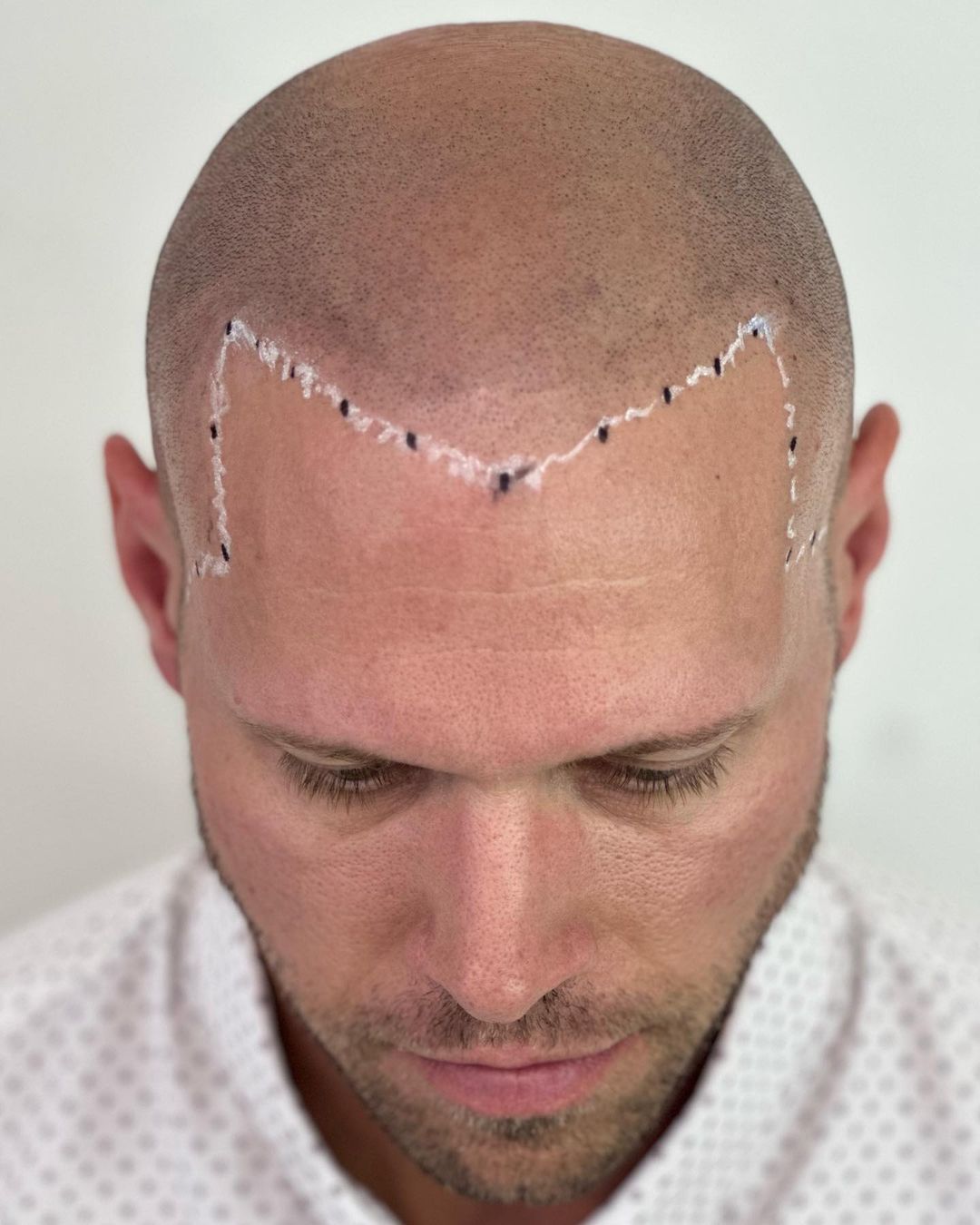 scalp micropigmentation in California