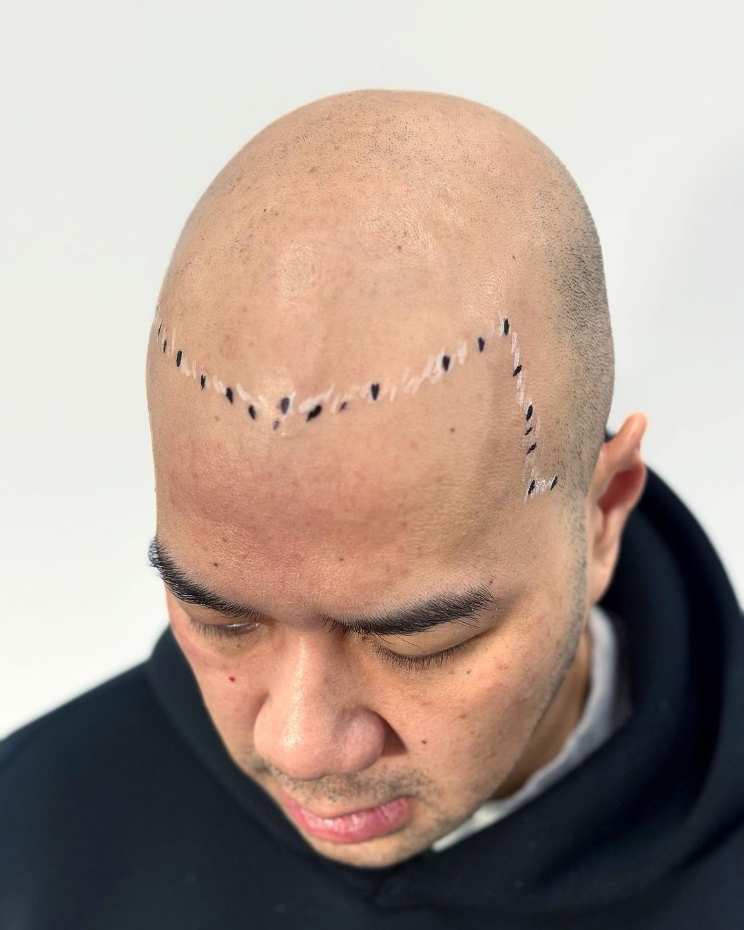 expert scalp micropigmentation