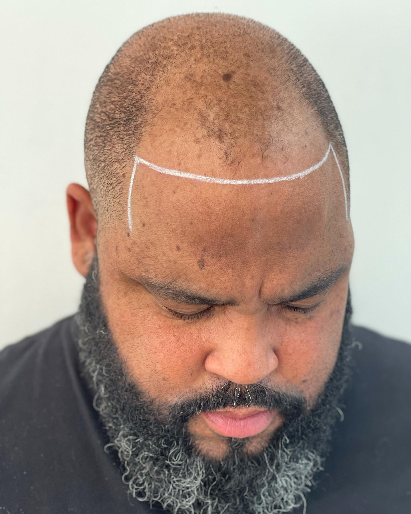 Picasso Jeff scalp micro pigmentation experts