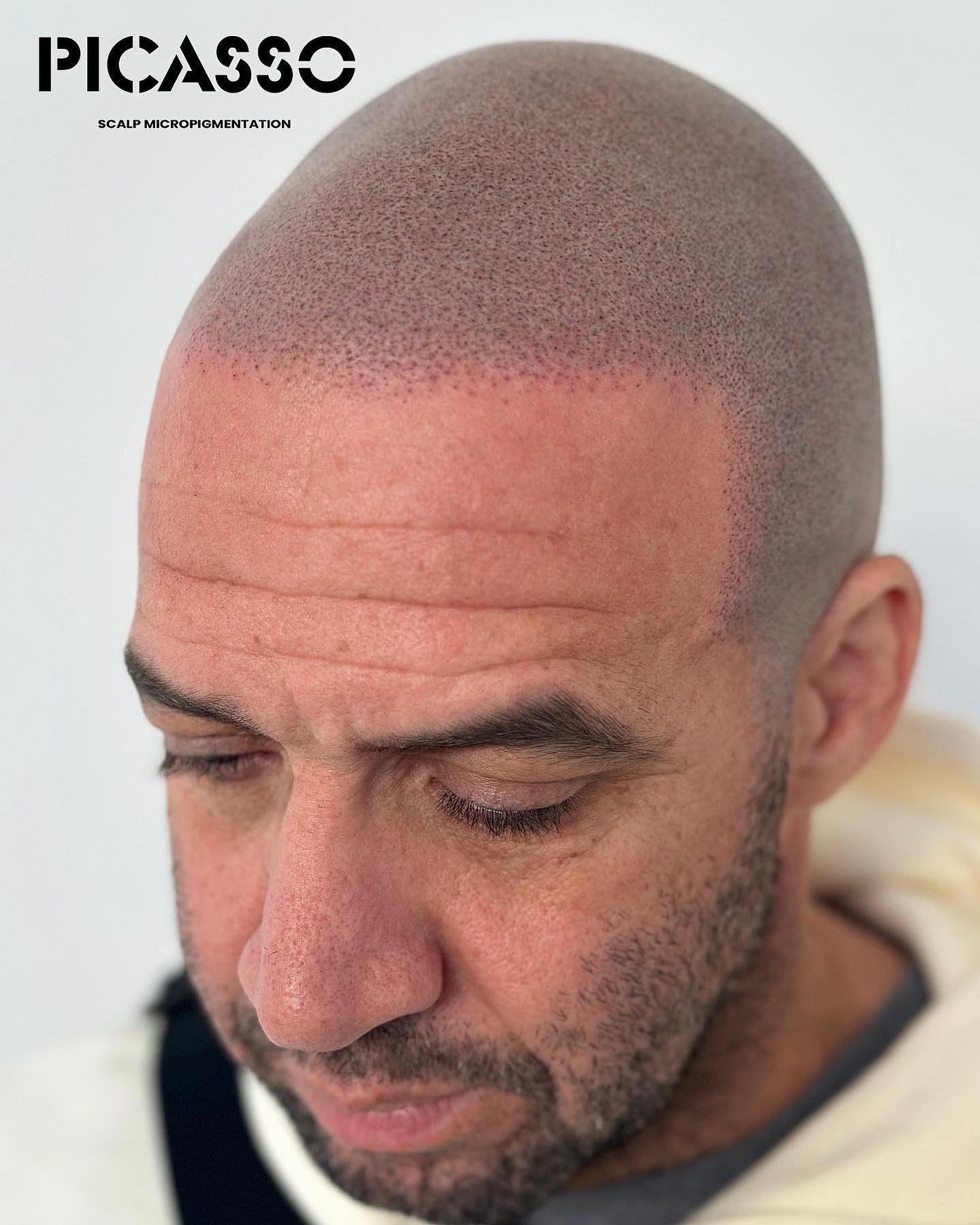 picasso jeff scalp micropigmentation experts