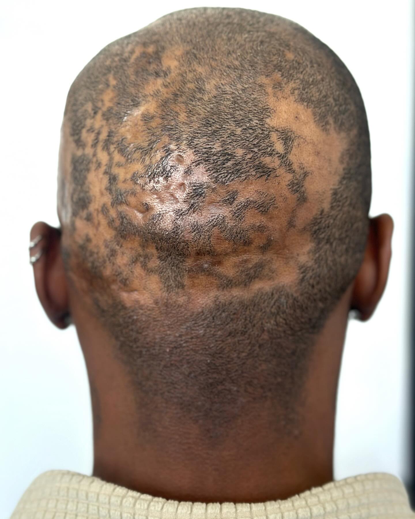 Scalp Micropigmentation (SMP)