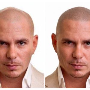 SMP Hairline Mockup – See Your New Look Before Treatment