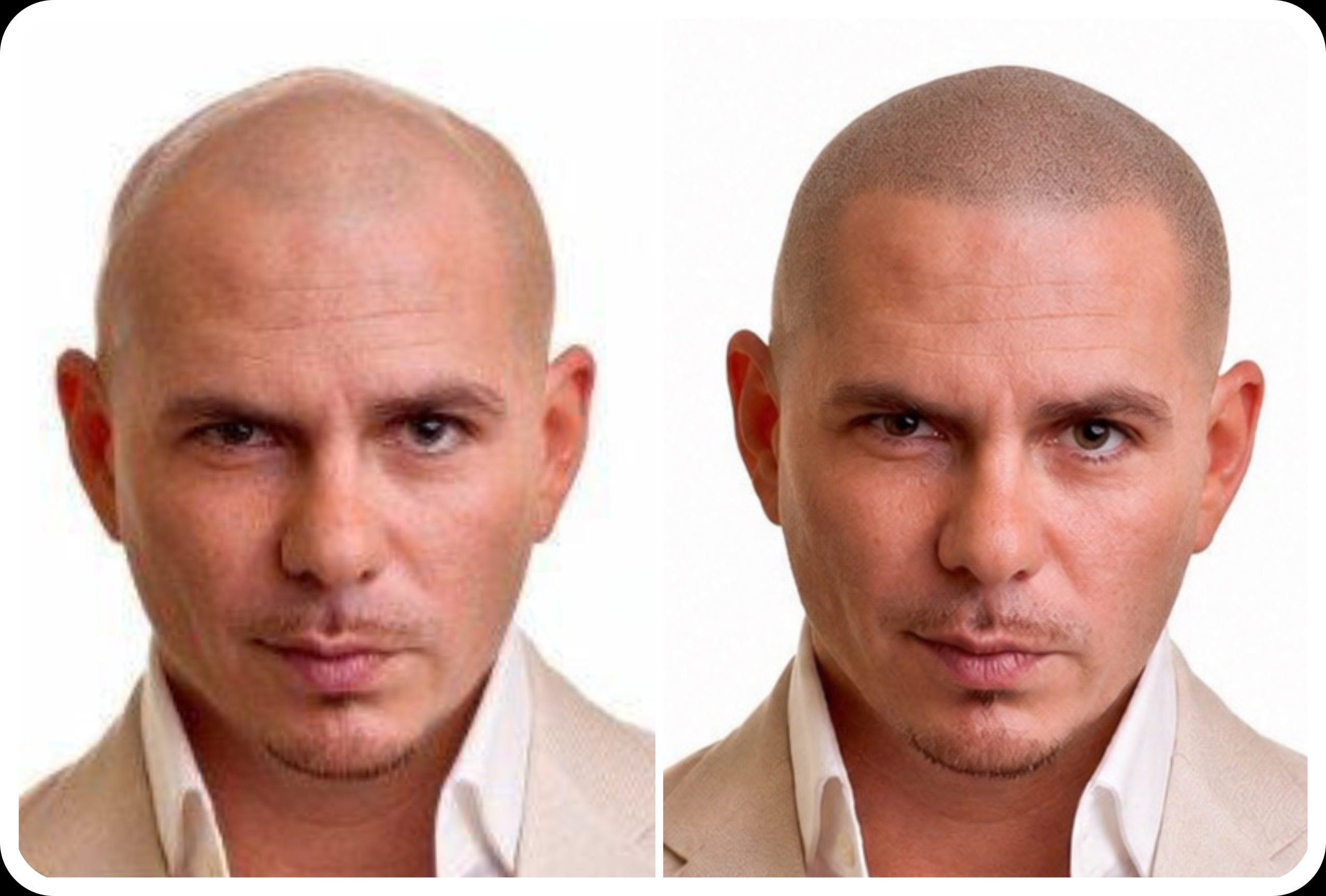 SMP Hairline Mockup – See Your New Look Before Treatment