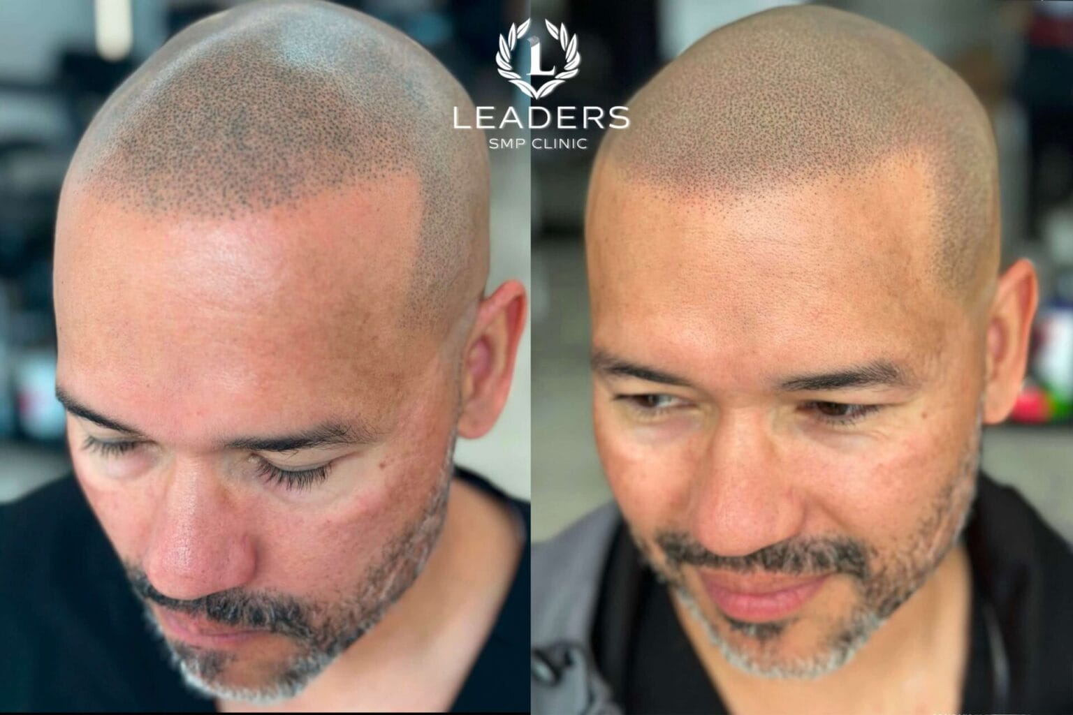 Leaders-SMP-Clinic-scalp-micropigmentation-smp-13--1536x1024