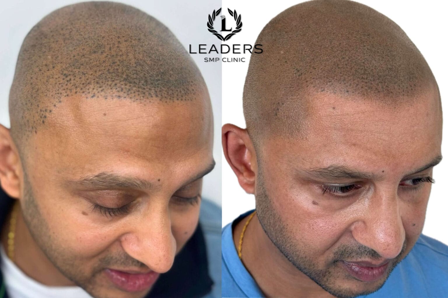 Leaders-SMP-Clinic-scalp-micropigmentation-smp-14--1536x1024