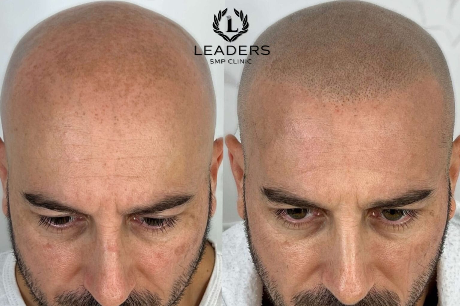 Leaders-SMP-Clinic-scalp-micropigmentation-smp--1536x1024