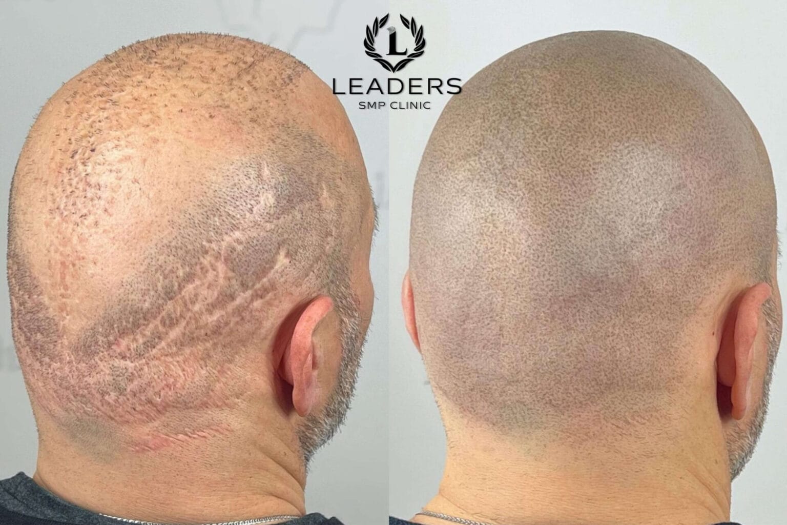 Leaders-SMP-Clinic-scalp-micropigmentation-smp-16--1536x1024