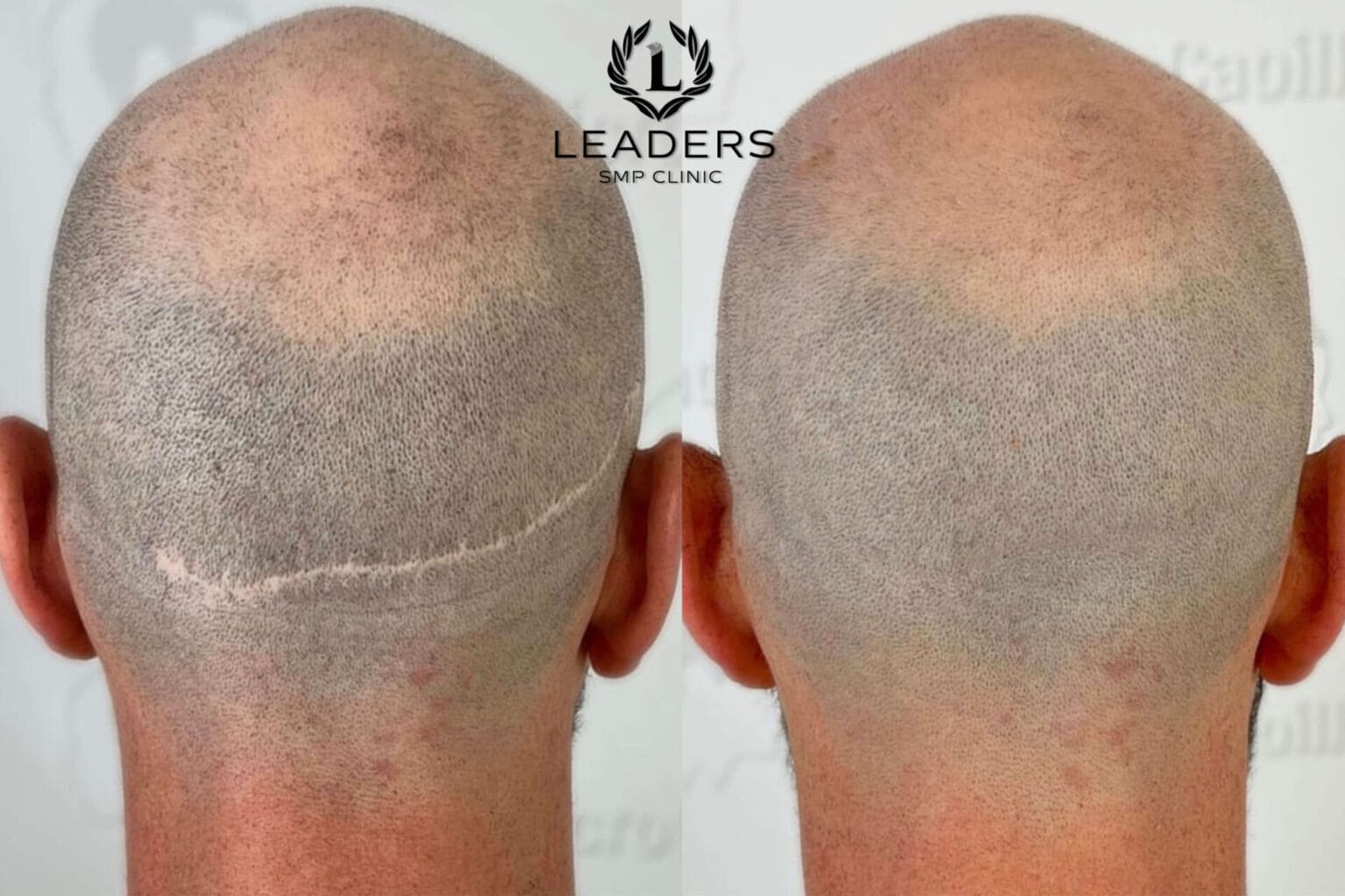 Leaders-SMP-Clinic-scalp-micropigmentation-smp-18--1536x1024