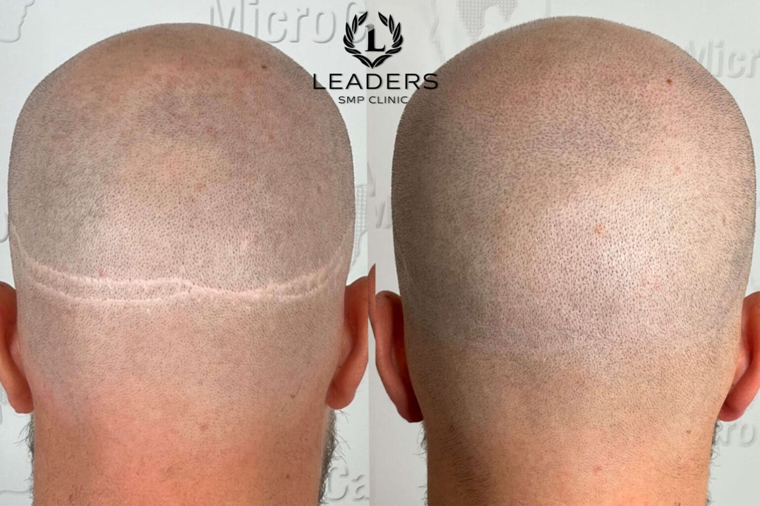 Leaders-SMP-Clinic-scalp-micropigmentation-smp-19--1536x1024