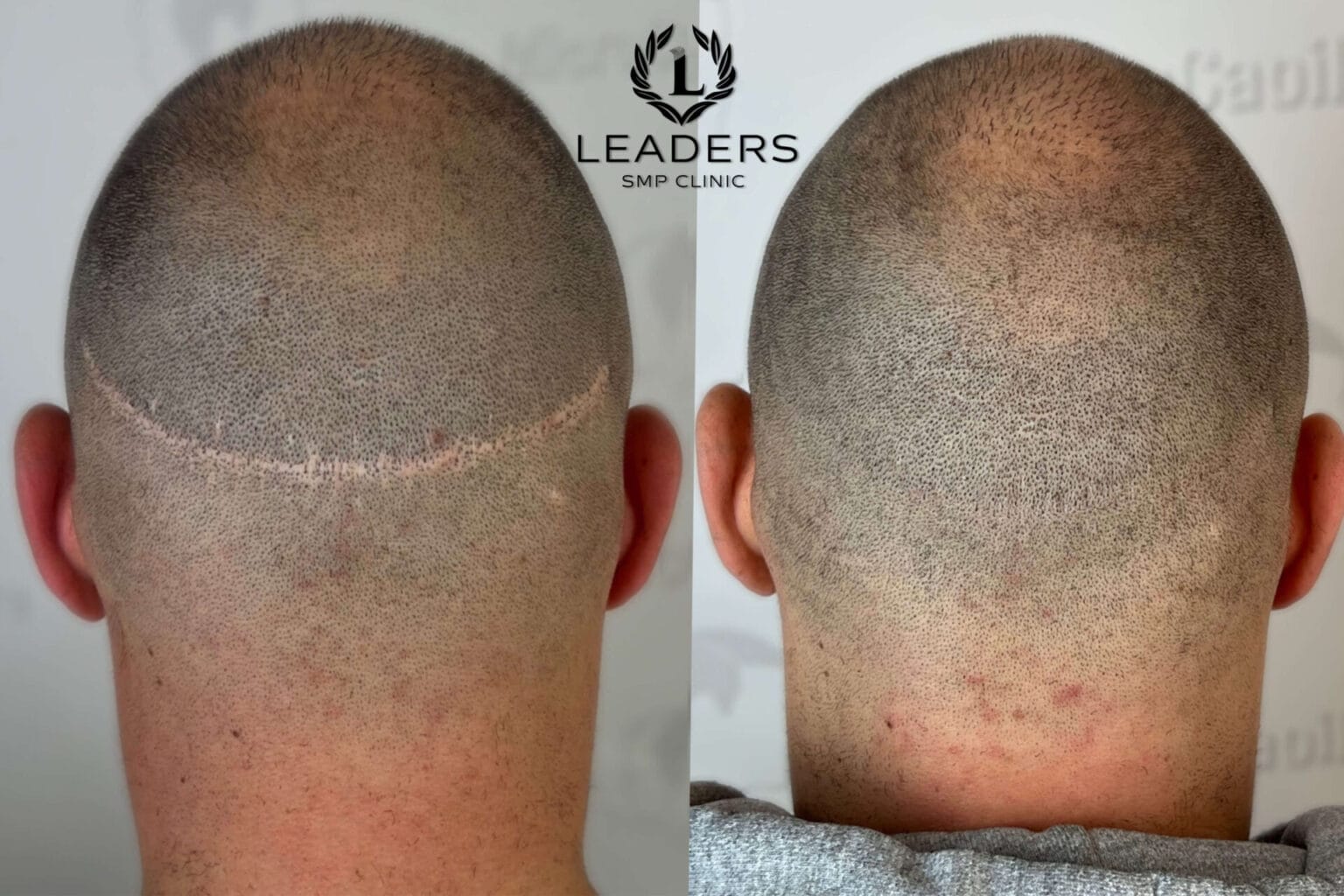 Leaders-SMP-Clinic-scalp-micropigmentation-smp-20--1536x1024