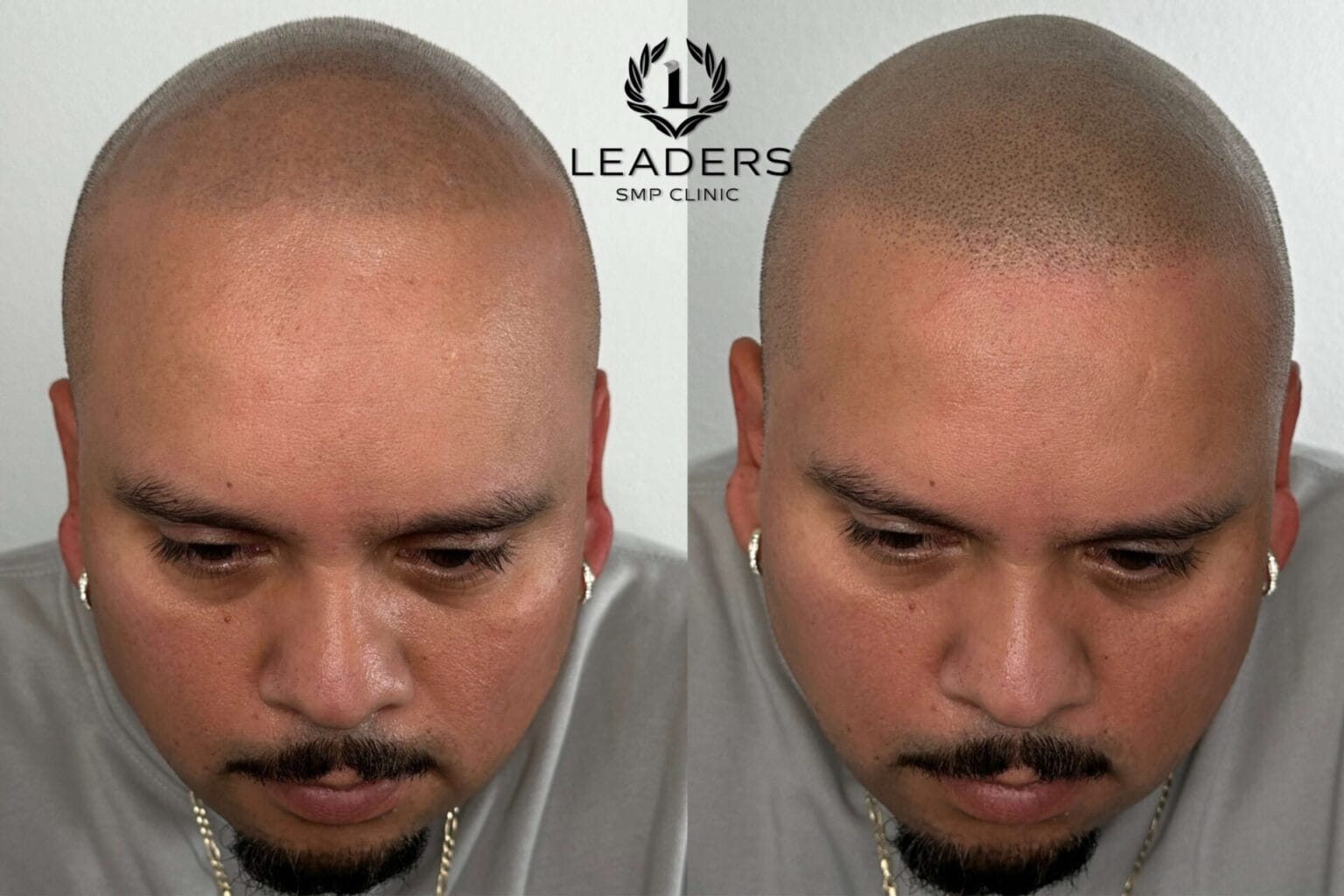 Leaders-SMP-Clinic-scalp-micropigmentation-smp-28--1536x1024