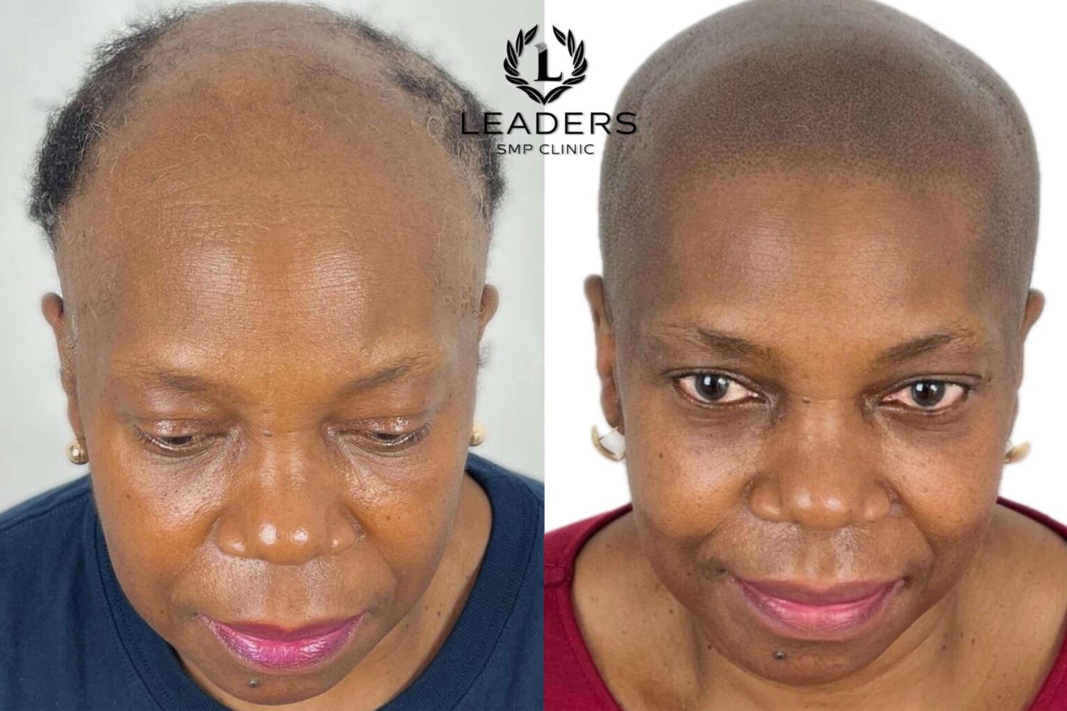 Leaders-SMP-Clinic-scalp-micropigmentation-smp-31--1536x1024