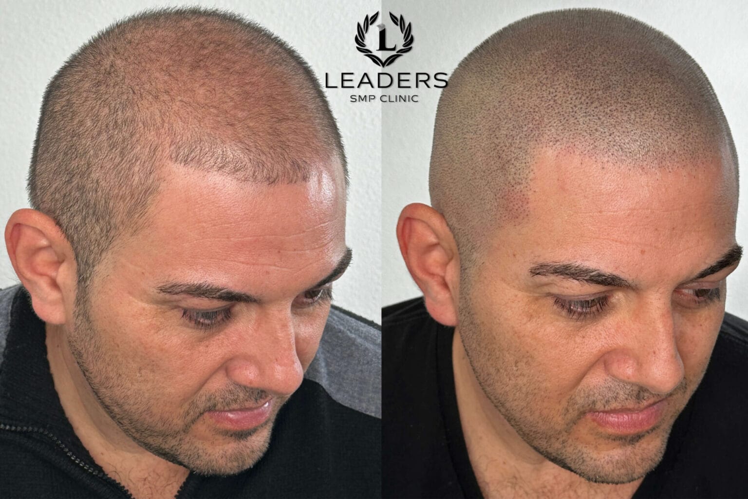 Leaders-SMP-Clinic-scalp-micropigmentation-smp-35--1536x1024