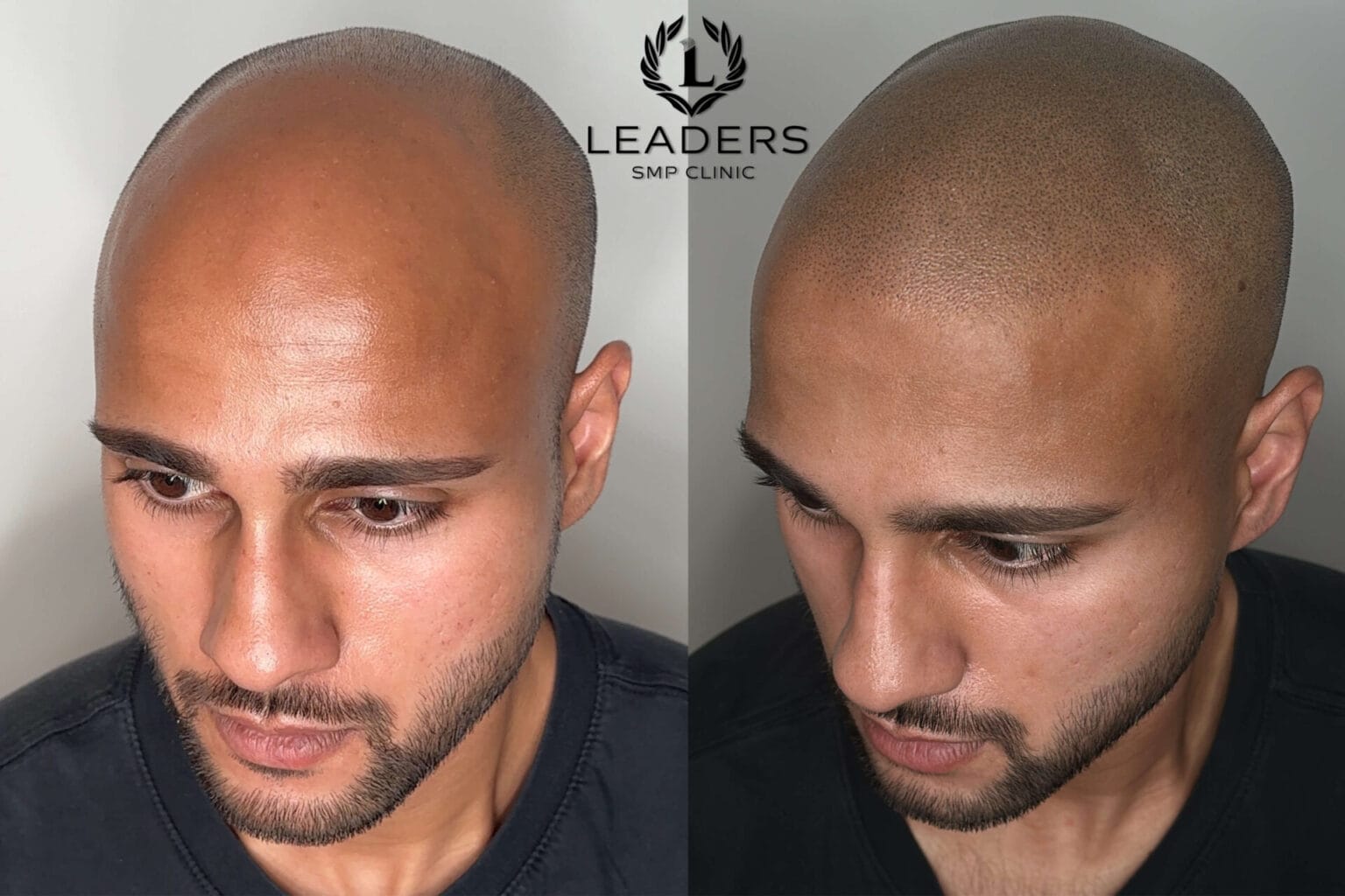Leaders-SMP-Clinic-scalp-micropigmentation-smp-36--1536x1024
