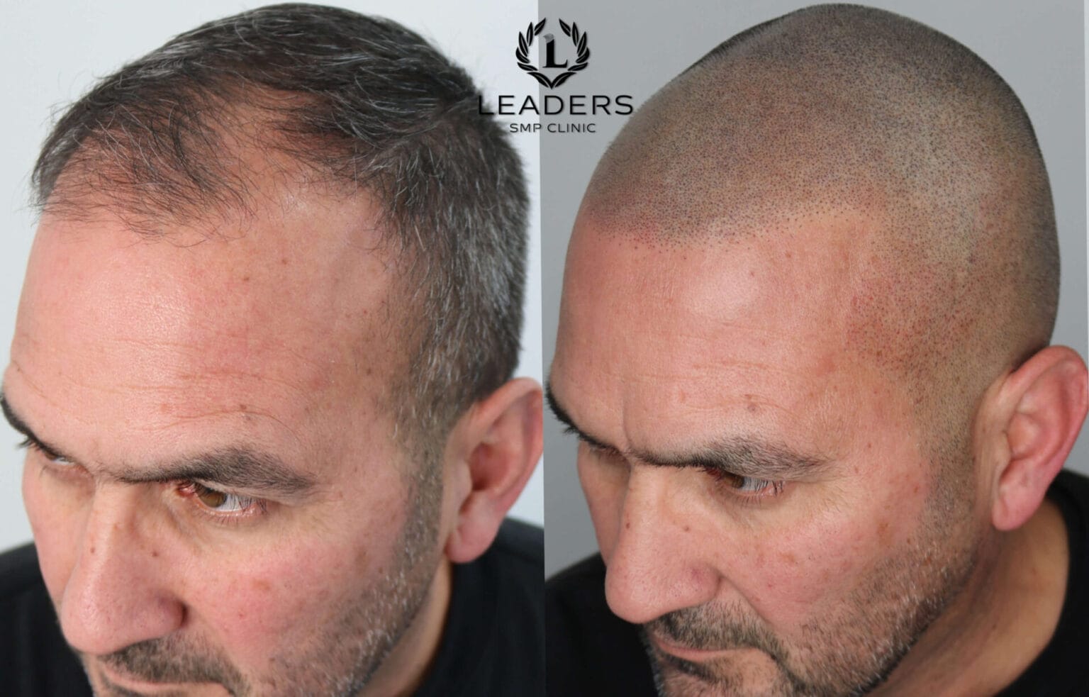 Leaders-SMP-Clinic-scalp-micropigmentation-smp-37--1536x983