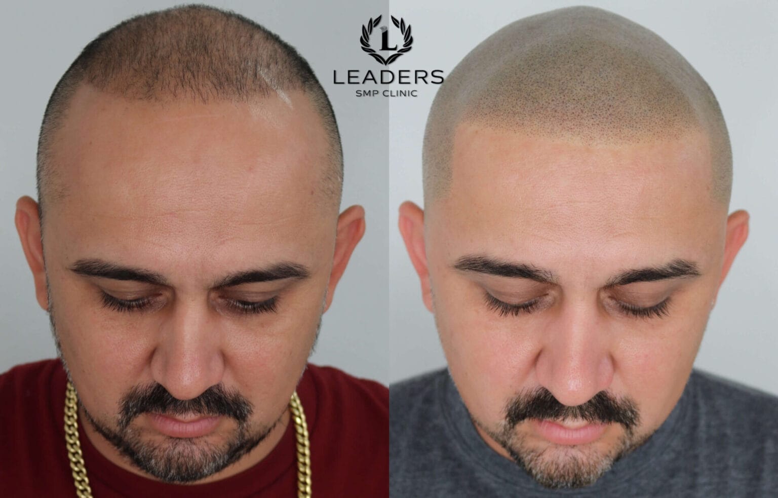 Leaders-SMP-Clinic-scalp-micropigmentation-smp-38--1536x983