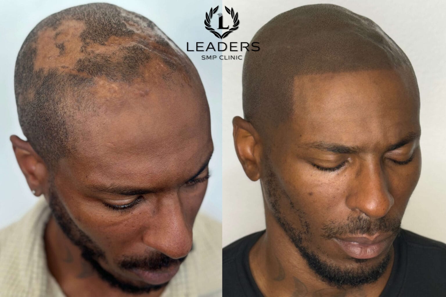 Leaders-SMP-Clinic-scalp-micropigmentation-smp-41--1536x1024