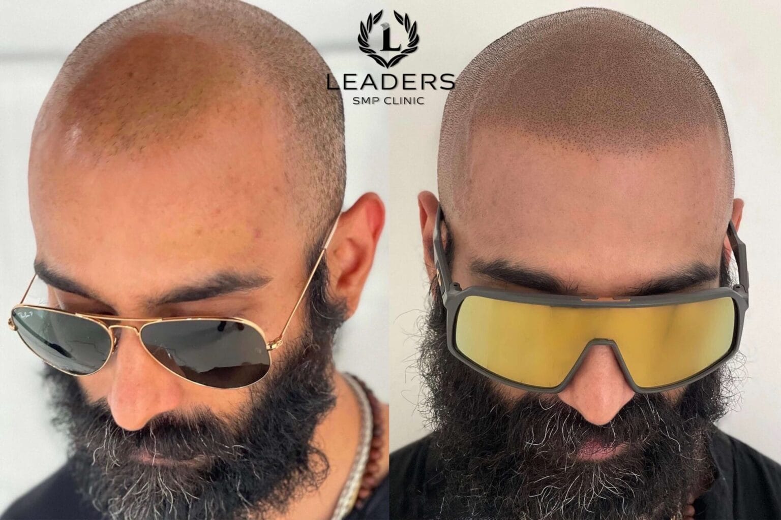 Leaders-SMP-Clinic-scalp-micropigmentation-smp-42--1536x1024