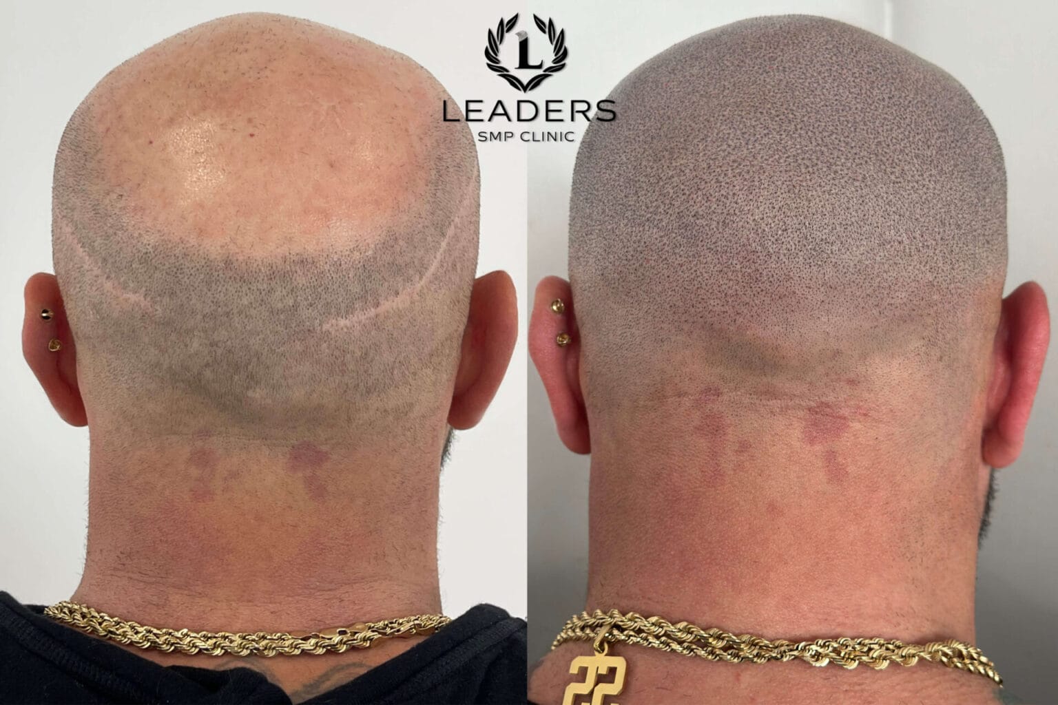 Leaders-SMP-Clinic-scalp-micropigmentation-smp-43--1536x1024