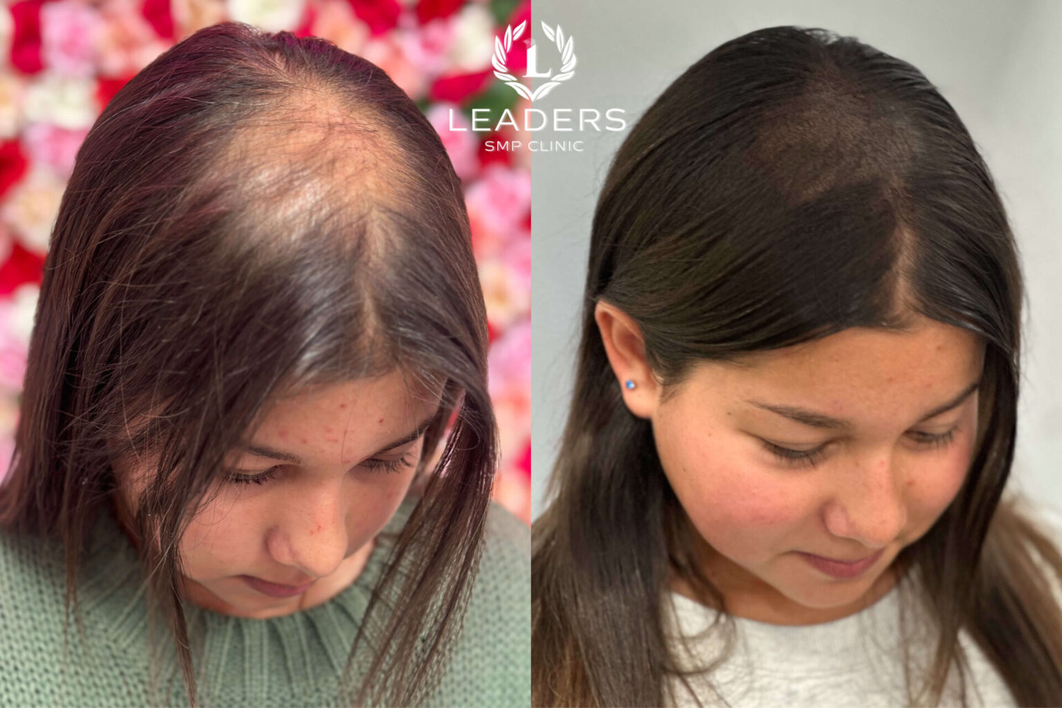 Leaders-SMP-Clinic-scalp-micropigmentation-smp-5--1536x1024
