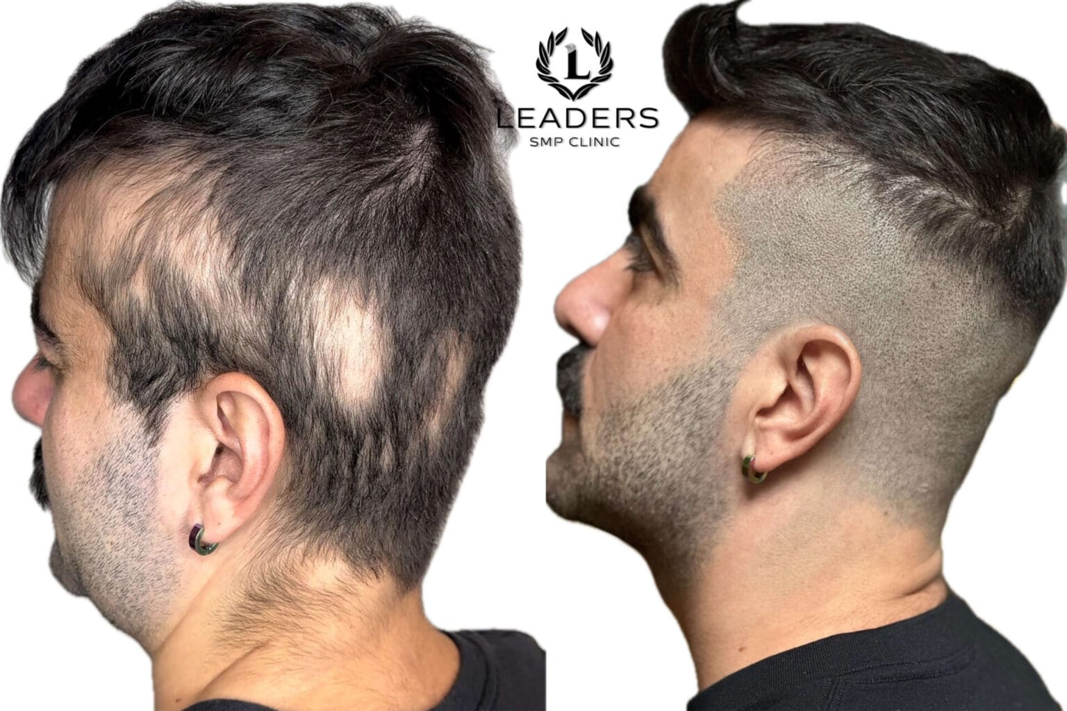 Leaders-SMP-Clinic-scalp-micropigmentation-smp-52--1536x1024