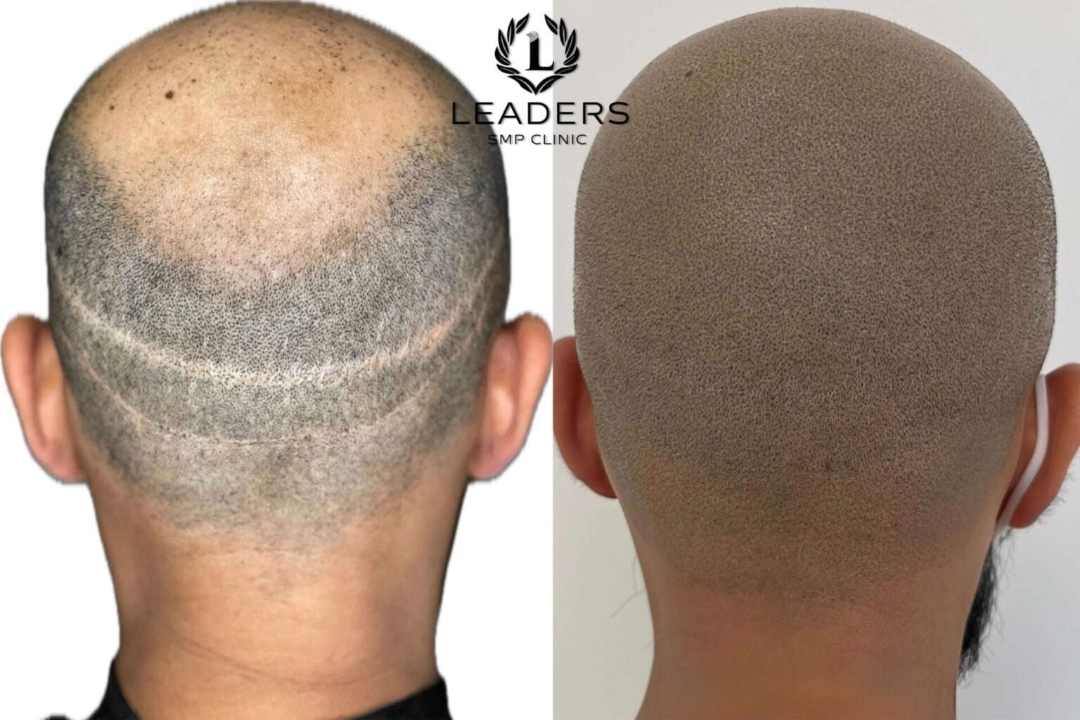 Leaders-SMP-Clinic-scalp-micropigmentation-smp-53--1536x1024