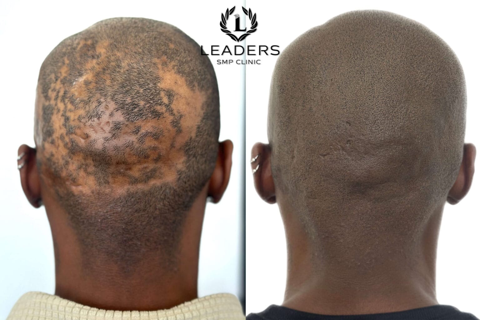 Leaders-SMP-Clinic-scalp-micropigmentation-smp-54--1536x1024