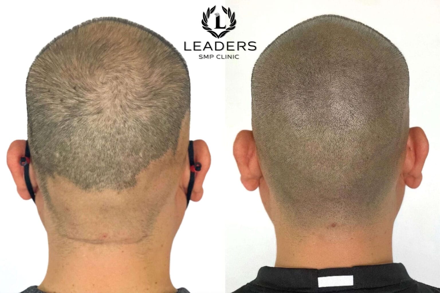 Leaders-SMP-Clinic-scalp-micropigmentation-smp-55--1536x1024