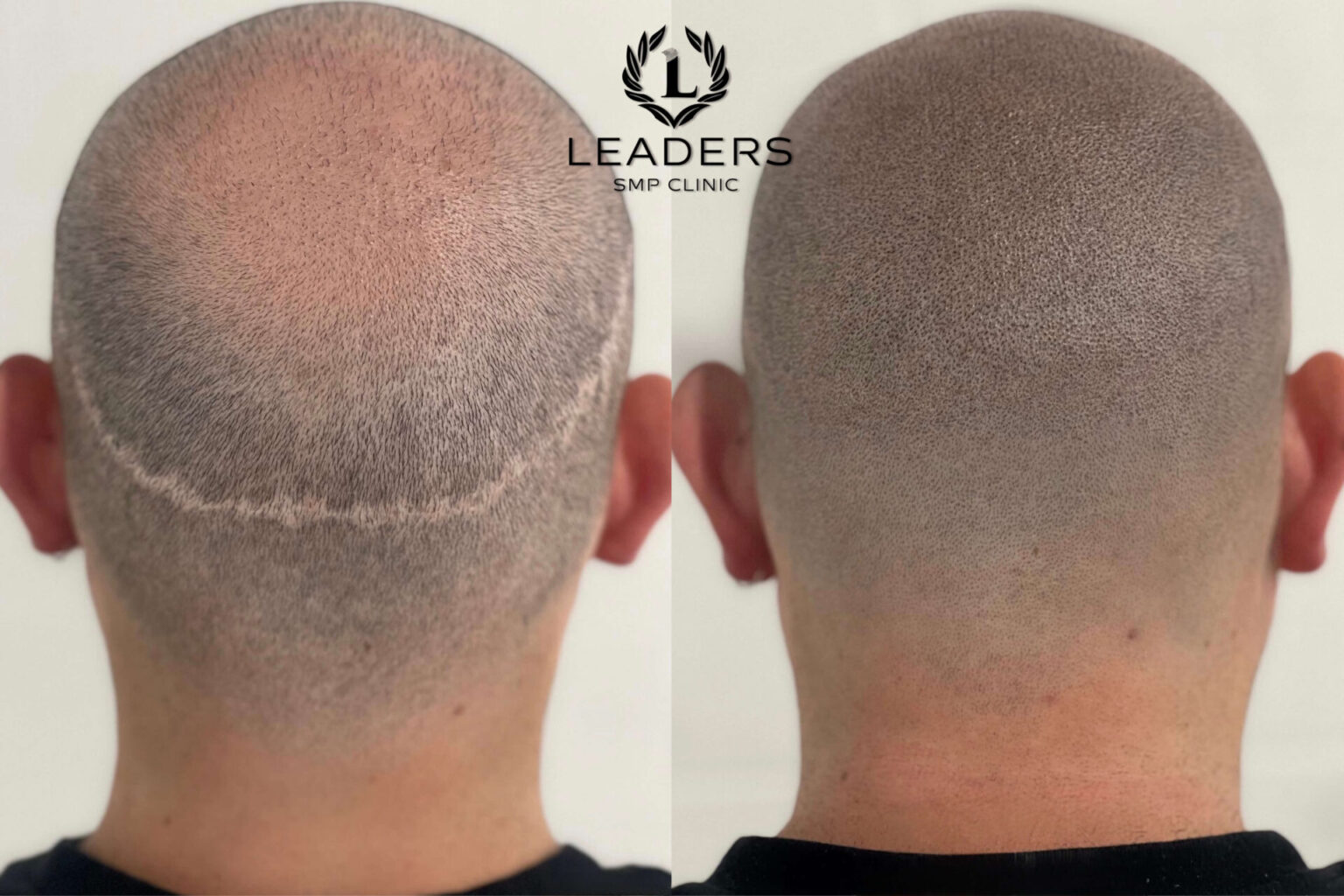 Leaders-SMP-Clinic-scalp-micropigmentation-smp-58--1536x1024