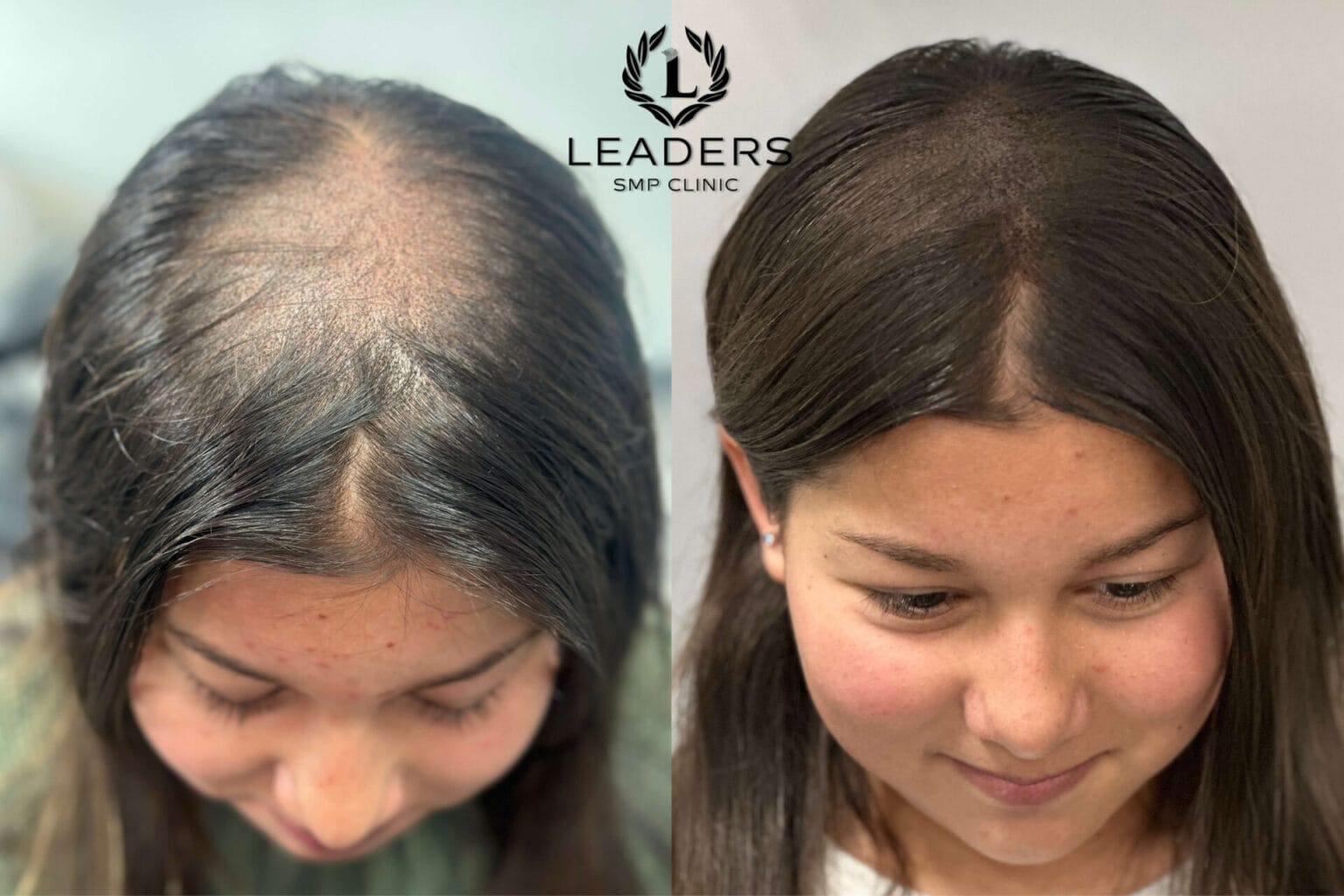 Leaders-SMP-Clinic-scalp-micropigmentation-smp-6--1536x1024