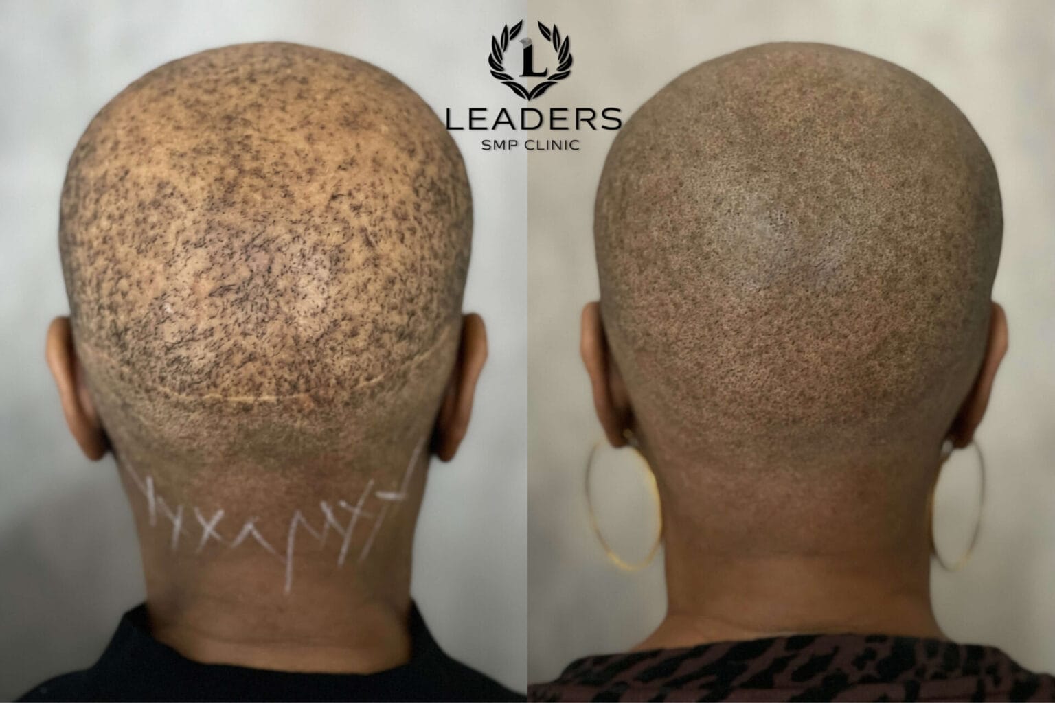 Leaders-SMP-Clinic-scalp-micropigmentation-smp-60--1536x1024