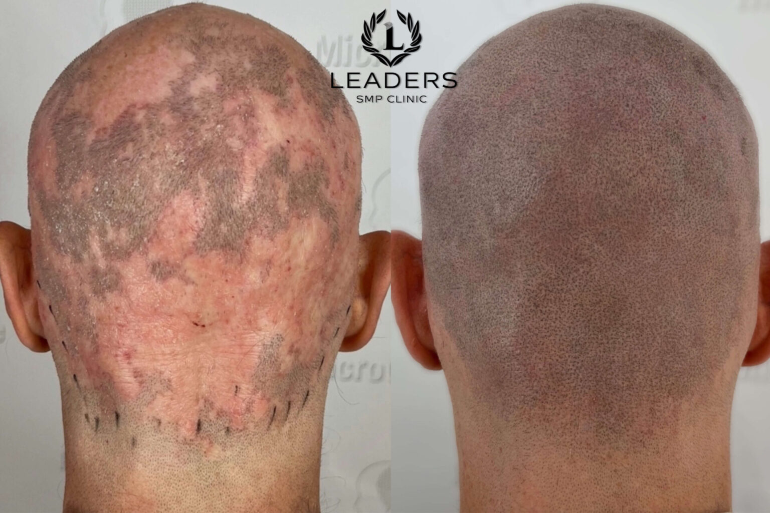 Leaders-SMP-Clinic-scalp-micropigmentation-smp-63--1536x1024