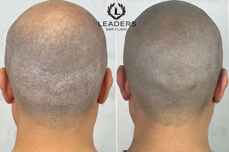 Leaders-SMP-Clinic-scalp-micropigmentation-smp-64--1536x1024