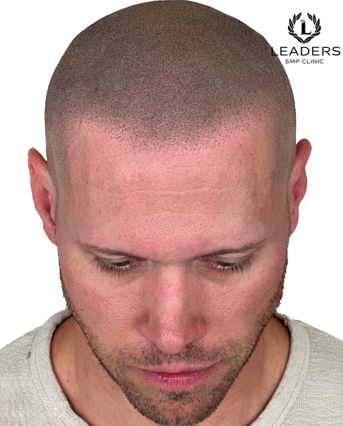 Leaders-SMP-Clinic-scalp-micropigmentation-smp-66